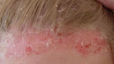 stádia vývoje a příznaky psoriázy