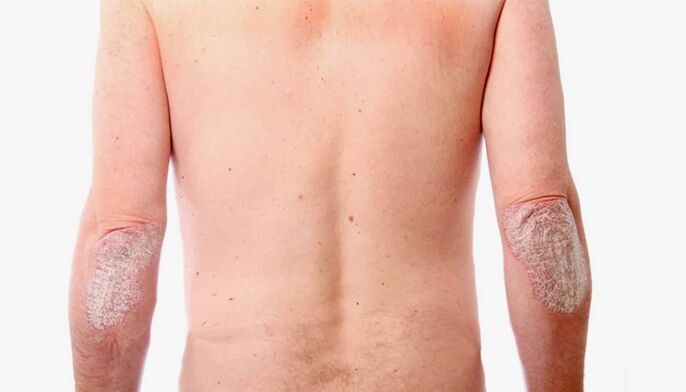 lidové prostředky pro léčbu psoriázy