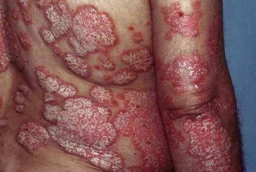 Psoriáza
