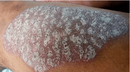 Patogeneze psoriázy