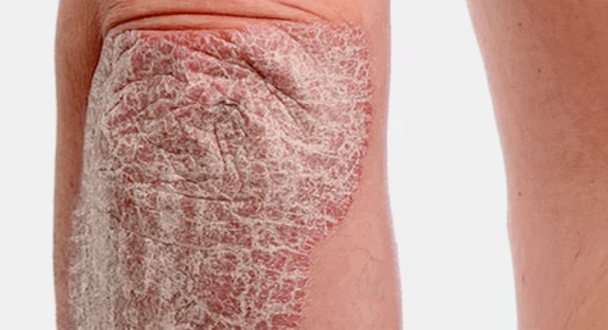 Psoriáza