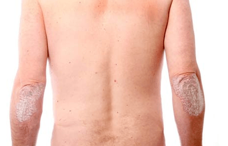 Obecné příznaky psoriázy