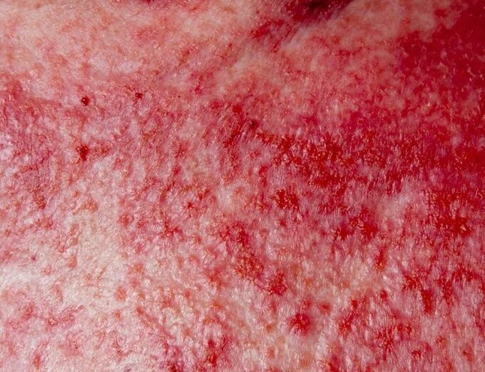 Pokročilá forma psoriázy