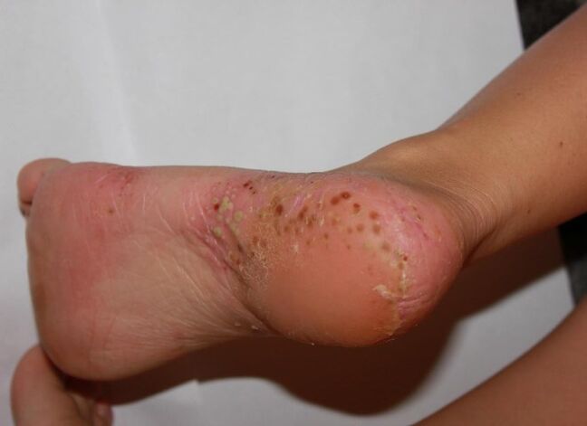 Palmoplantární psoriáza