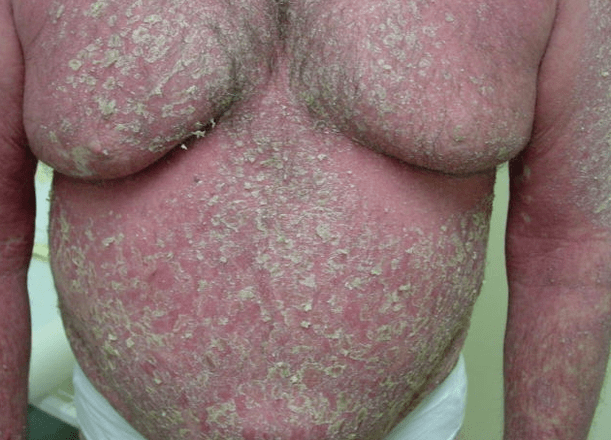 Psoriatická erytrodermie na těle